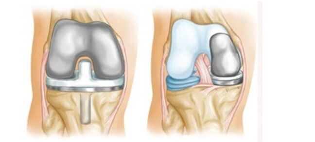 Endopróteses para a artrose da articulación do xeonllo