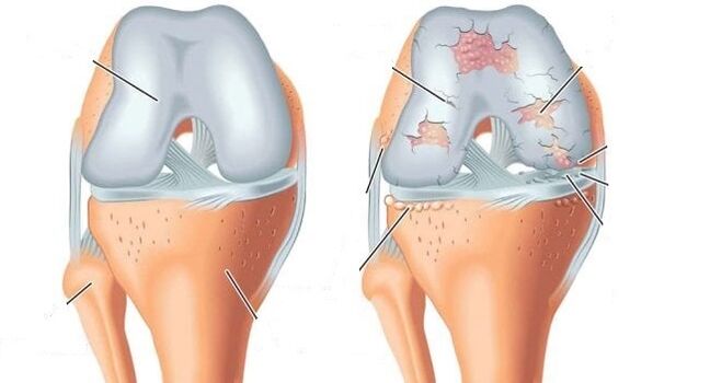 articulación saudable e artrose da articulación do xeonllo