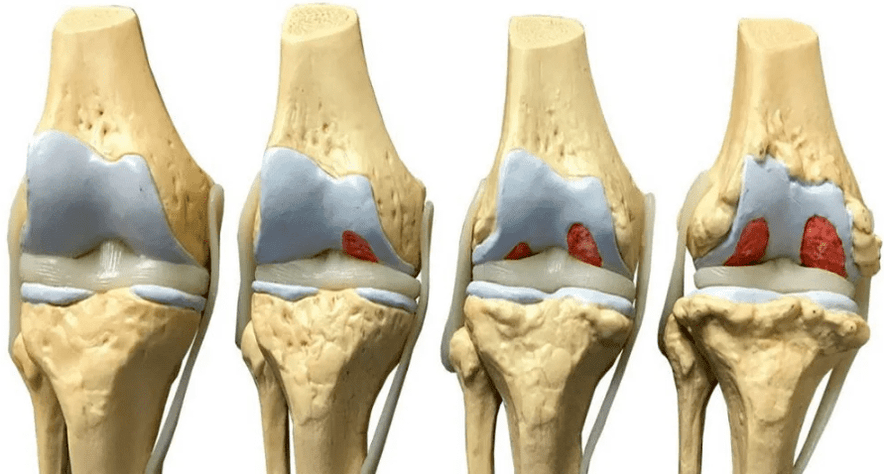 Danos na articulación do xeonllo en varias etapas do desenvolvemento da artrose