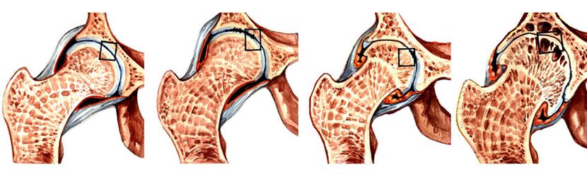 O grao de desenvolvemento da artrose na articulación da cadeira