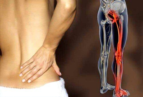 Dor nas costas debido á inflamación do nervio ciático