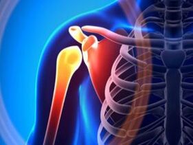 Articulación do ombreiro inflamada debido á artrose - unha enfermidade crónica do sistema músculo-esquelético