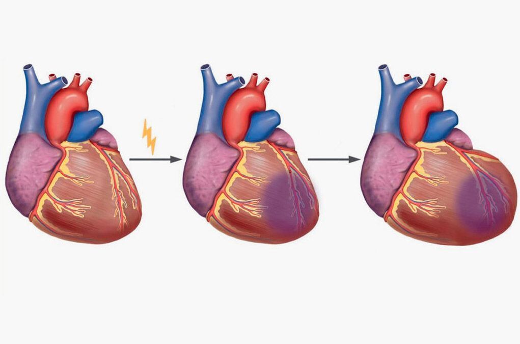 Un ataque cardíaco causa dor nos omóplatos