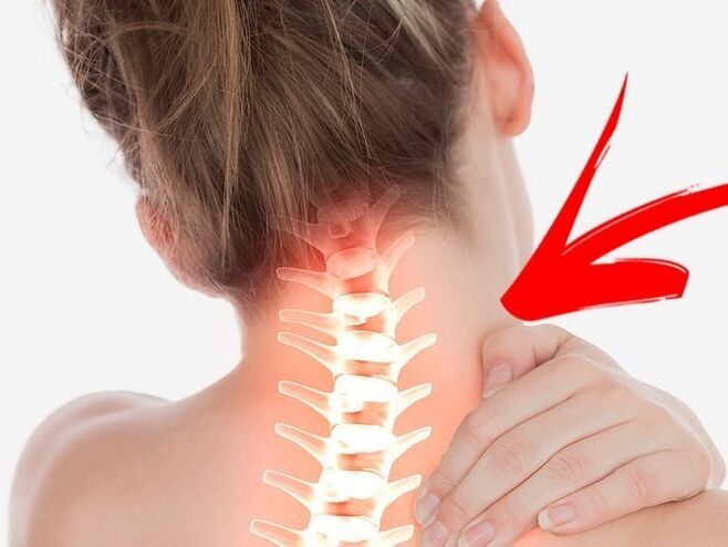 Compresión de raíces nerviosas con osteocondrose cervical