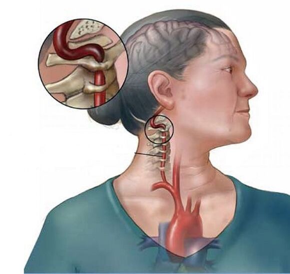 Síndrome da arteria vertebral con osteocondrose cervical
