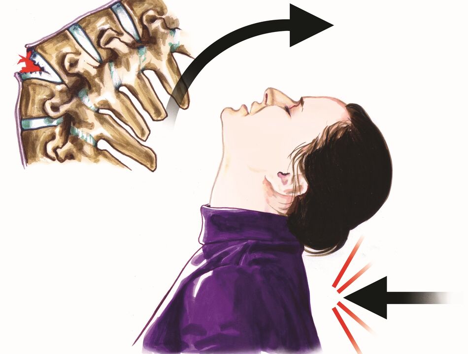 O dano na columna vertebral como causa da dor no pescozo